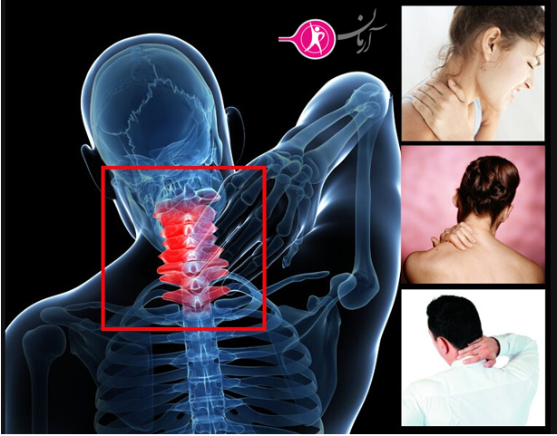 علت بروز آرتروز گردن چيست؟