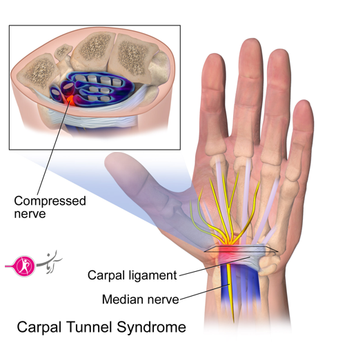 راه‌های درمان سندرم تونل کارپال..._قسمت 2