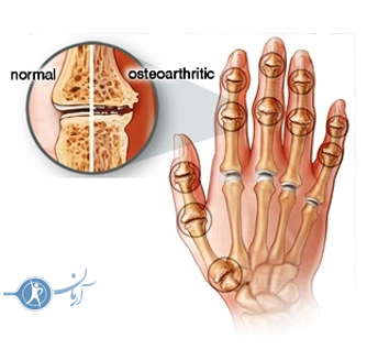 آرتریت انگشت دست چیست؟