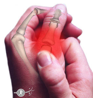 آرتریت انگشت دست چیست؟