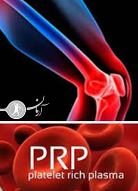 پی آر پی PRP برای درمان آرتروز زانو...